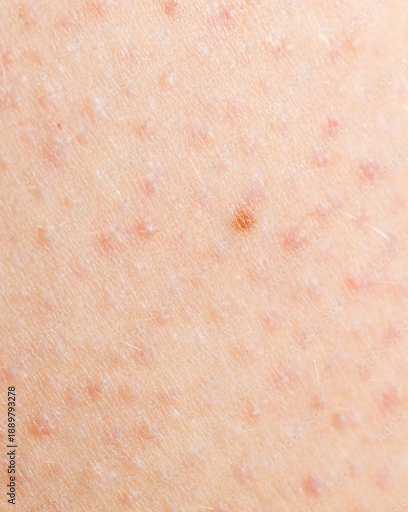 Fototapeta premium A person has a rash on their arm