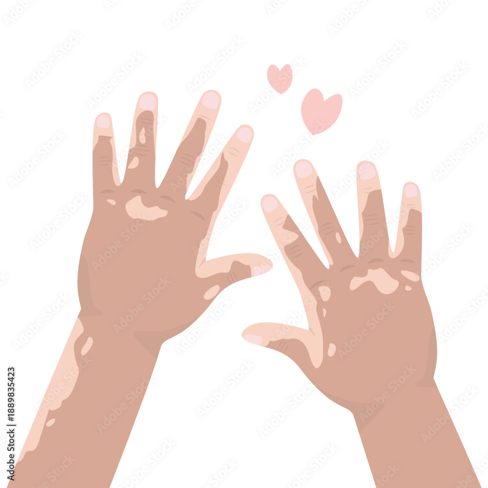 Fototapeta premium Hands with vitiligo, parts of body. Person with pigmentation on skin. Character with Vitiligo skin problems. Close Up, top view. World Vitiligo Day.
