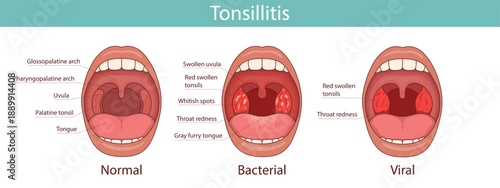Medical anatomical illustration. Tonsillitis can be bacterial or viral in nature. Infection of the tonsils. Open mouth, anatomy.