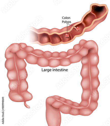 Medical illustration of large intestine anatomy showing colon polyps on inner intestinal wall. Educational digestive system diagram. Gastroenterology and colorectal disease