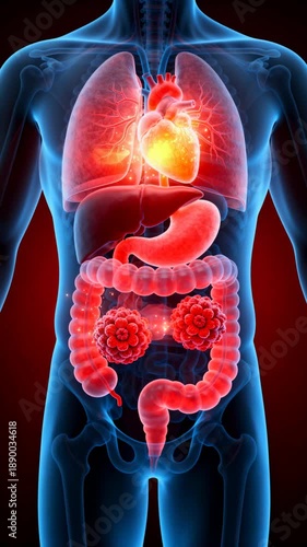 Medical illustration of colon cancer tumors showing human internal organs.