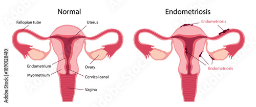Endometriosis. Comparison diagram showing a normal uterus and endometriosis. The normal uterus illustration includes labels for the fallopian tube, uterus, ovary, endometrium, myometrium, cervical can