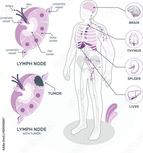 Human lymphatic system with tumor metastasis illustration,A detailed vector illustration of the human lymphatic system, highlighting lymph nodes, brain, thymus, spleen, and liver, with an emphasis on 