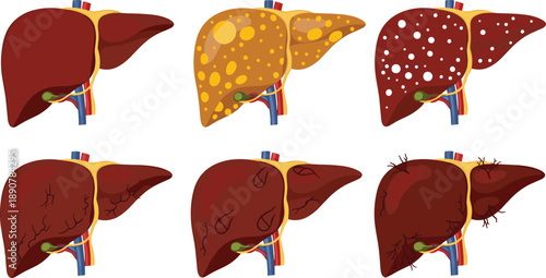 Human liver disease progression illustration showing healthy liver fatty liver hepatitis fibrosis cirrhosis stages medical anatomy infographic isolated on white background vector design