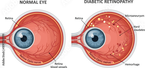 Comparison of normal eye and diabetic retinopathy anatomy illustration highlighting retinal damage, hemorrhage, microaneurysm and exudates for medical education, ophthalmology awareness