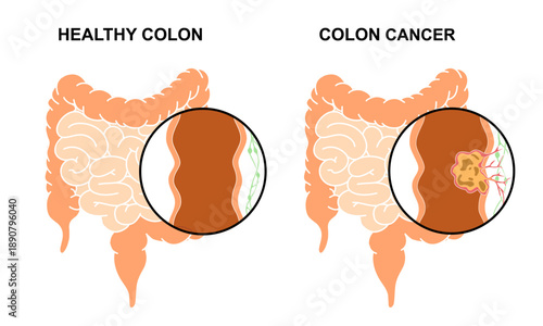 Illustration of colorectal cancer. Comparison of healthy colon with colon cancer. Concept of colon cancer. Medical vector illustration for clinics, education, and science.