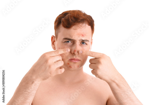 Teenage boy with acne squis...
