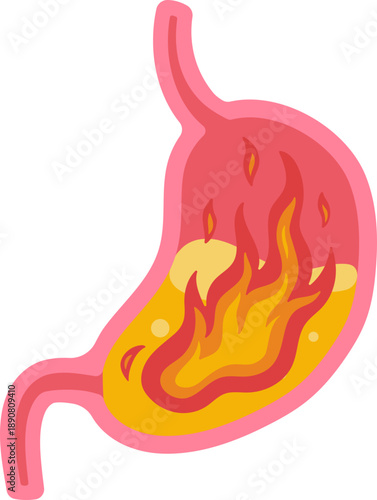 Heartburn causes by Acid Reflux or Inflamed Stomach