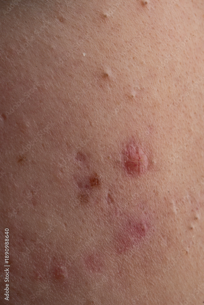 Fototapeta premium Acne and pimple,on skin closeup. Acne macro, pimple on skin. Pimple texture in pores. Pimple macro for dermatology.