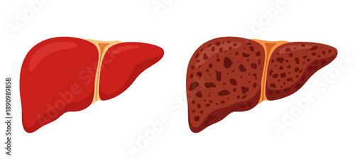 Healthy red liver contrasted with diseased brown liver showing cirrhosis and damage human organ