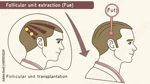fue vs fut hair transplantation illustration