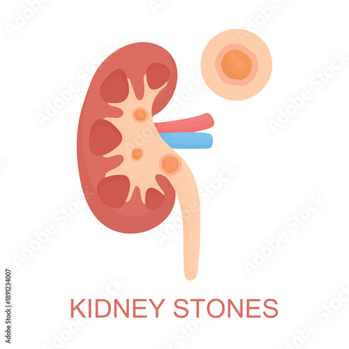 Vector illustration of a human kidney with stones isolated on white background. Clear visual concept of kidney problems, pain, discomfort, urology issues, health warning, disease awareness