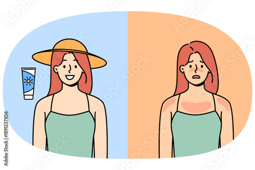 Woman with sunburn smiles after using sunscreen to protect from ultraviolet light. Girls are encouraged to use cream-gel to save themselves from summer sun, which causes sunburn on face and body
