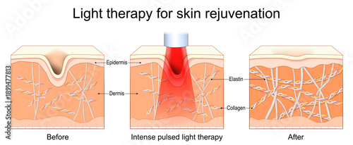 Anti-Aging Facial Rejuvenation. Light therapy for skin problems