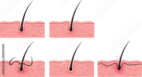 Ingrown hair stages illustration, hair follicle inflammation, skin irritation diagram, dermatology problem, shaving rash medical concept