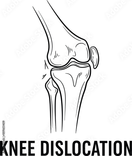 Anatomy illustration of a human knee joint showing the effects of a severe dislocation