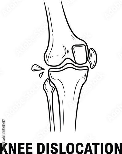 Anatomy illustration showing a knee dislocation with bones out of normal alignment