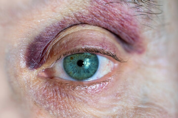 Eye senior man showing signs bruising, redness and hemorrhage. Medical condition, injury, hematoma, and healing process, blood vessel, violence and accident