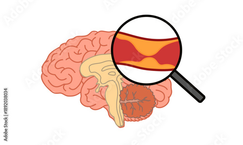 Ischemic stroke concept. Cholesterol in human blood vessels. Arteriosclerosis, infarct, ischemia, thrombosis disease. blocked vascular, fatty streak, plaque. vector illustration for medical.