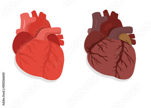 Comparison of Healthy and Unhealthy Human Heart Vector Illustration for Medical Concept 