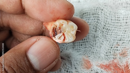 Close-up of a freshly extracted human tooth showing damage and signs of dental work