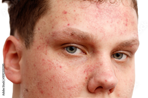 Canvas Print A man with a red face and blue eyes
