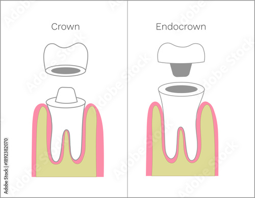 Crown and Endocrown types of dental repair, flat illustration.