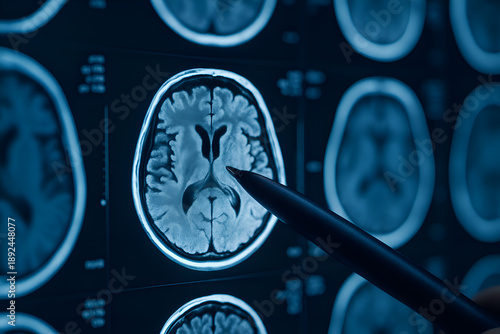 Close-up of a pen pointing at a detailed MRI scan of a human brain on a digital screen