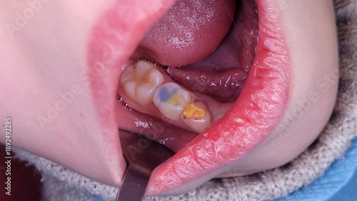 Child's primary molar tooth with blue sealants