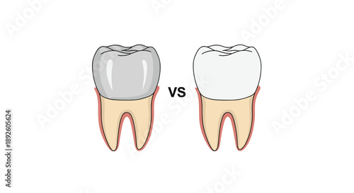 Comparison Diagram of Two Teeth with Grey and White Crowns Labeled with VS on White Background