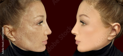 CO2 laser treatment ,Cosmetic Laser Dermatology 