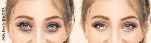 Lower and upper Blepharoplasty.Marking the face.Perforation lines on females face, plastic surgery concept.