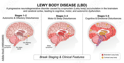 Lewy Body Disease (LBD) Medical Flashcard