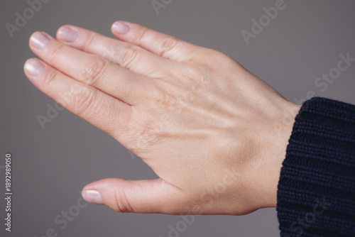 Canvas Print Female right back hand with ganglion cyst on the dorsum,  fluid-filled bump associated with a joint or tendon sheath, close-up view, selected focus