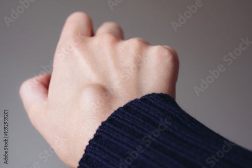 Female right back hand with ganglion cyst on the dorsum,  fluid-filled bump associated with a joint or tendon sheath, close-up view, selected focus.