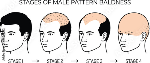Stages of male pattern baldness illustration showing hair loss progression, medical infographic of alopecia development, flat vector design