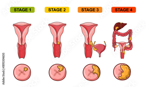 Cervical Cancer stage Illustration Concept, the growth of cancer cells in the cervix. vector illustration for medical, education, science, and the concept of disease in reproductive organs.