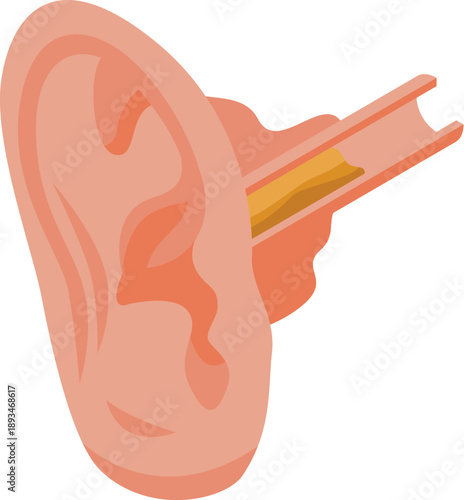 Earwax buildup is causing blockage in the ear canal, illustrating potential ear related issues