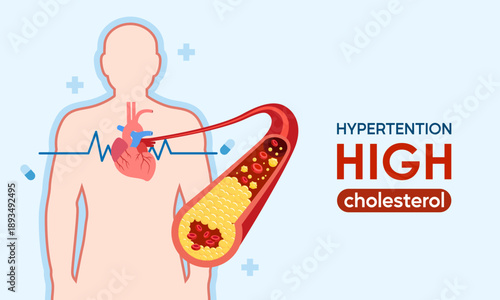 Illustration illustrating unhealthy Coronary conditions with high cholesterol.