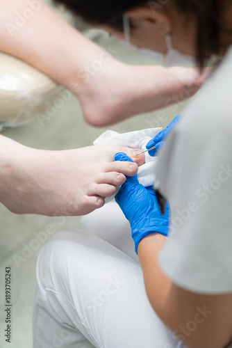 Close-up of a podiatrist treating an ingrown toenail in a salon