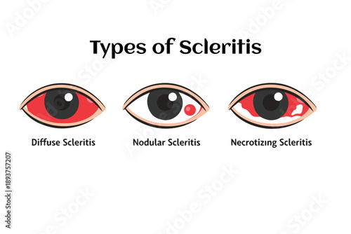 Diffuse Nodular Necrotizing Scleritis Types 2D Flat Infographic