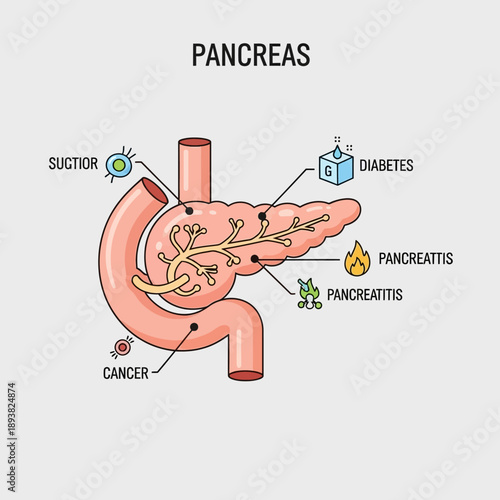 Pancreas Anatomy Diagram: Diabetes, Cancer, Pancreatitis, Suction