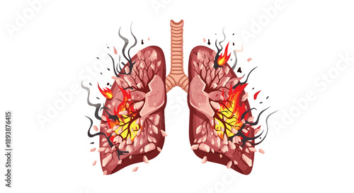 Graphic Medical Illustration of Inflamed Human Lungs Burning with Intense Orange Fire and Thick Black Smoke.