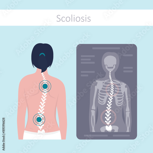 Educational poster, unhealthy back and scoliosis. Woman with disorders of musculoskeletal system. Example of scoliosis, infographic. Spinal curvature on x-ray.