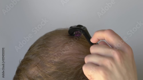 Man with early hair thinning receives microneedling scalp treatment using roller to activate follicles, improve circulation, and prepare skin for hair transplant procedure. Roller for scalp health