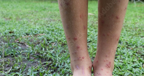 Legs of a child with black fly bites in an Atlantic Forest region.