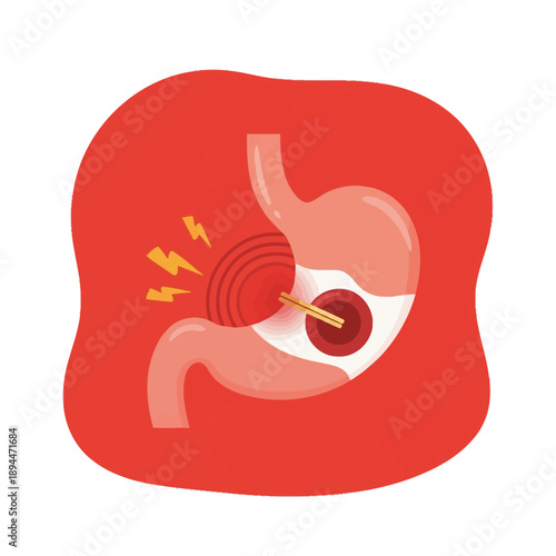 Stomach pain illustration with ulcer and inflammation, digestive system health concept.