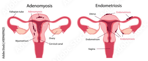 Comparison diagram showing the Adenomyosis and Endometriosis. Female medical illustration includes labels for the fallopian tube, uterus, ovary, endometrium, myometrium, cervical canal. 