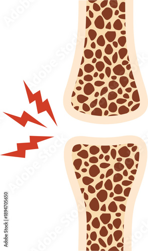 Osteoporosis Illustration