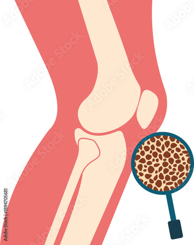 Osteoporosis Illustration